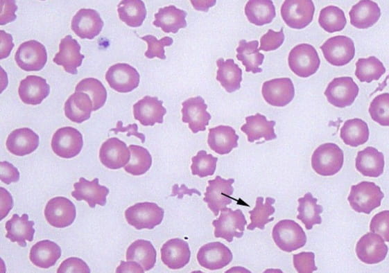 Normal and Abnormal Form of Red Blood Cells