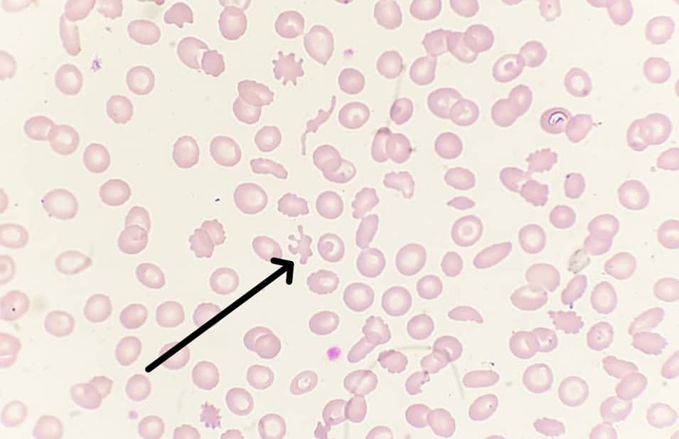 acanthocyte