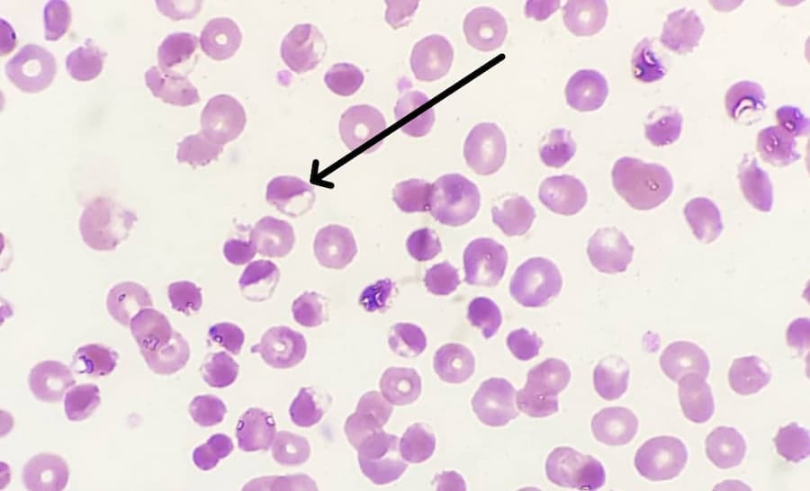 Normal and Abnormal Form of Red Blood Cells