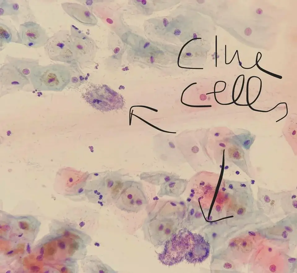 Clue cells Gram stain 