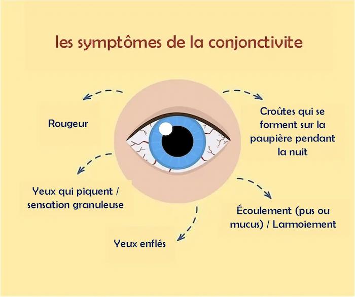 symptômes de la conjonctivite 