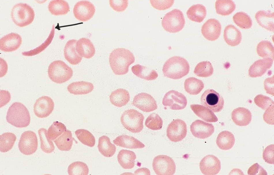 Drépanocytes