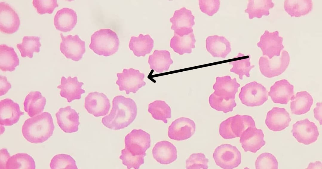 Échinocytes