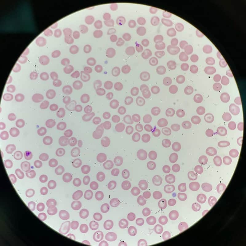 MGG-stained blood smear