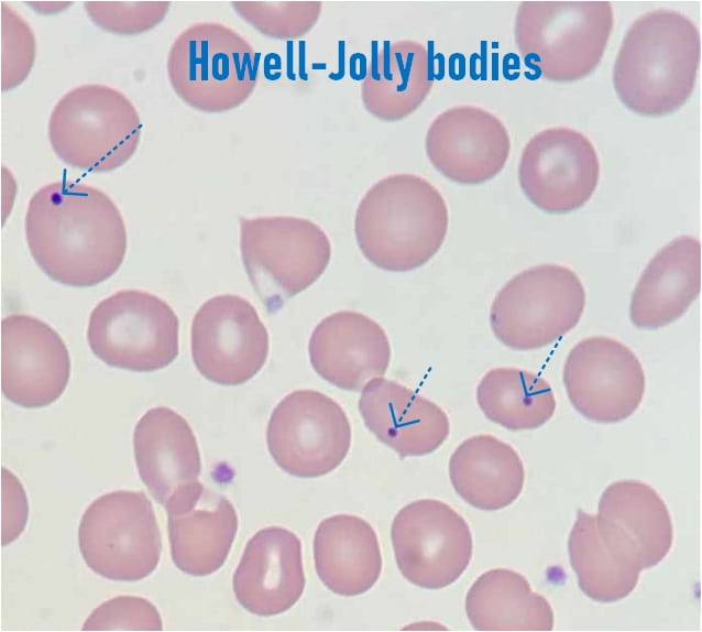 Howell-Jolly bodies