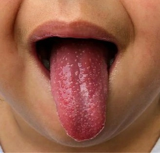 Scarlet fever Raspberry tongue