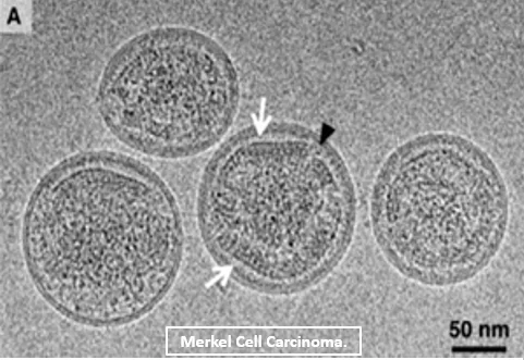 Polyomavirus à cellules de Merkel 