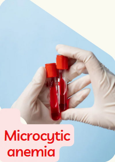 microcytic anemia