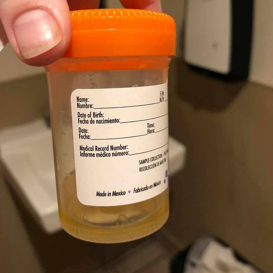 Mucus dans l'urine test