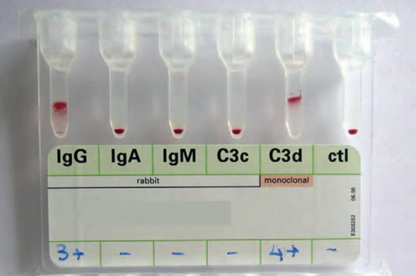  direct Coombs test