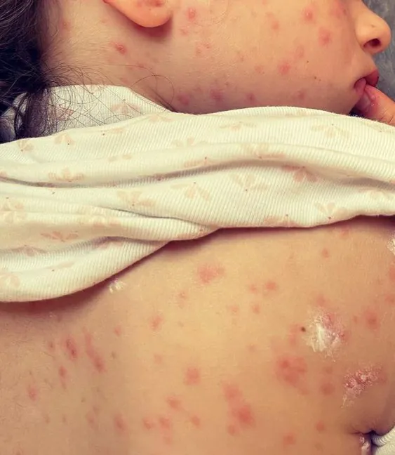 Chickenpox 